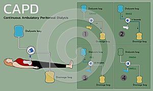 Continuous Ambulatory Peritoneal Dialysis (CAPD)