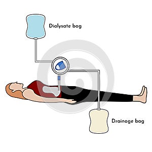 Continuous Ambulatory Peritoneal Dialysis (CAPD)