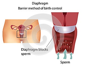 Contraceptive method- Diaphragm photo