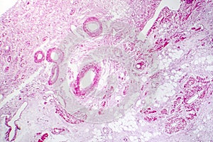 Contracted kidney, light micrograph