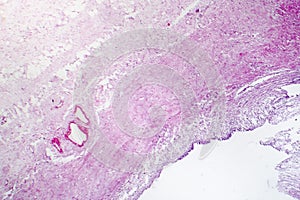 Contracted kidney, light micrograph