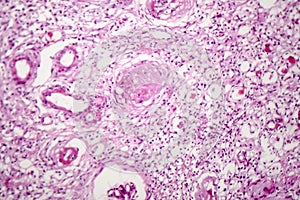 Contracted kidney, light micrograph