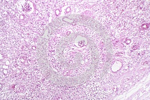 Contracted kidney, light micrograph