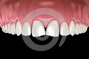 Convergent diastema of central incisors teeth. Dental disfunction 3D illustration concept photo