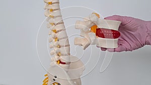 Convex red intervertebral disc herniation on model of spine