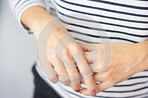 Cooking oil burn scar on a woman`s hands. Skin damage in first-degree on outer layer skin