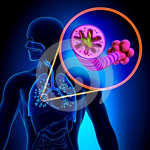 COPD - Chronic obstructive pulmonary disease