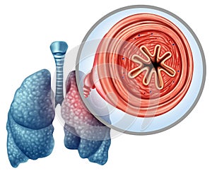 COPD chronic obstructive pulmonary disease