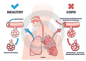 COPD or chronic obstructive pulmonary disease explanation outline diagram