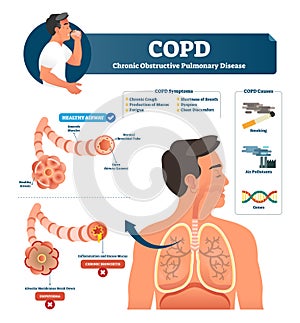 COPD vector illustration. Labeled chronic obstructive pulmonary explanation photo