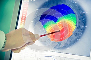 Corneal topography