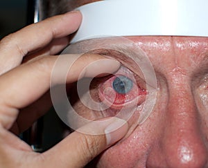 Corneal ulcer photo