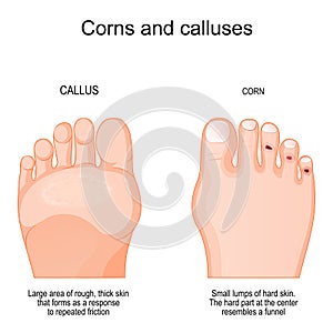 Corns on toe and calluses on sole