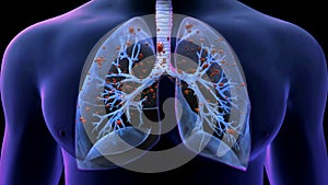 Corona virus attacking lungs.