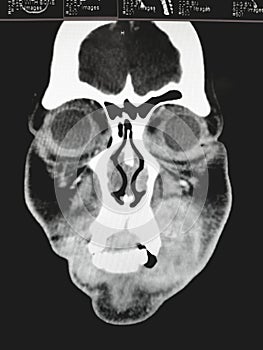 Coronal CT Scan of the Sinuses and Face