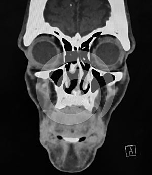 Coronal CT Scan of the Sinuses and Face
