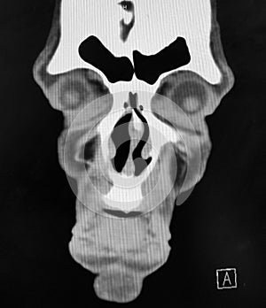 Coronal CT Scan of the Sinuses and Face