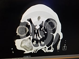 Coronal CT Scan of the Sinuses and Face - Right Maxillary Sinusitis