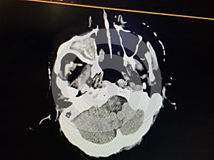 Coronal CT Scan of the Sinuses - Right Maxillary Sinusitis