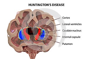 Coronal section of a brain of a person with Huntington`s disease