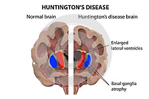 Coronal section of a brain of a person with Huntington`s disease