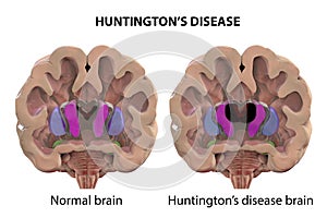 Coronal section of a brain of a person with Huntington`s disease photo