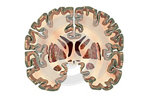 Coronal section of a healthy brain showing normal anatomy of basal baglia