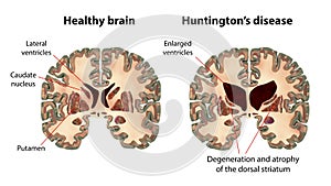 Coronal sections of a healthy brain and a brain in Huntington's disease photo