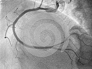 Coronary angiogram