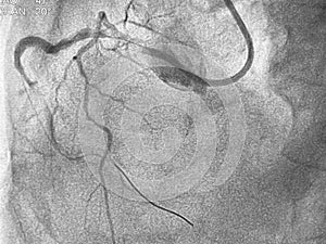 Coronary angiogram