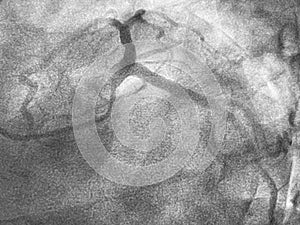 Coronary angiogram