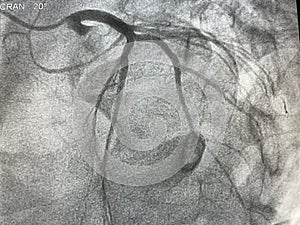 Coronary angiogram