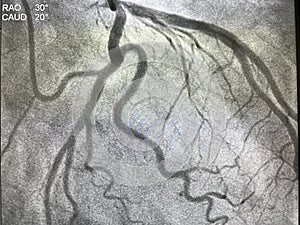 Coronary angiogram