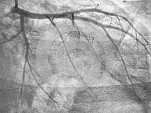 Coronary angiogram