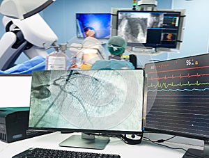 Coronary angiogram CAG on LCD monitor and Blurred of modern Cath Lab with the doctor, nurse, and patient in the operating room