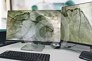 Coronary angiogram CAG  on LCD morniter  and Blurred of modern Cath Lab with doctor, nurse and patient in hospital Cath Lab