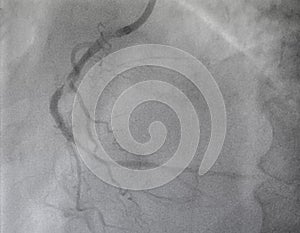 Coronary angiogram , medical x-ray