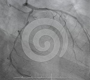Coronary angiogram , medical x-ray
