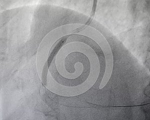 Coronary angiogram , medical x-ray photo