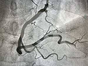 Coronary angiogram photo