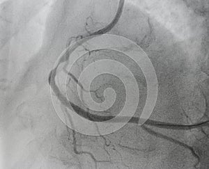 Coronary angiogram , medical x-ray photo
