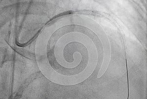 Coronary angiogram , medical x-ray photo