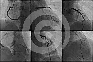 Coronary angiography