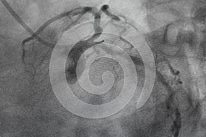 Coronary angiography, Coronary artery disease.