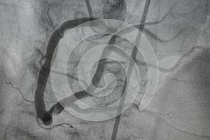 Coronary angiography, Coronary artery disease.