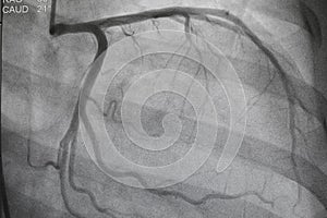 Coronary angiography, Coronary artery disease.