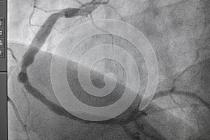 Coronary angiography, Coronary artery disease.