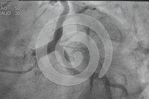 Coronary angiography, Coronary artery disease.