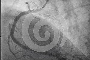 Coronary angiography, Coronary artery disease.