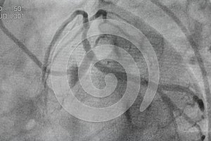 Coronary angiography, Coronary artery disease.